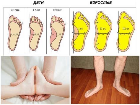 Методы лечения плоскостопия 1 степени у подростка