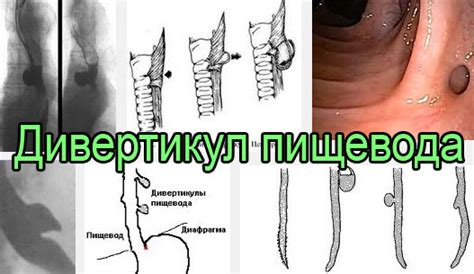 Методы лечения утолщения стенки пищевода