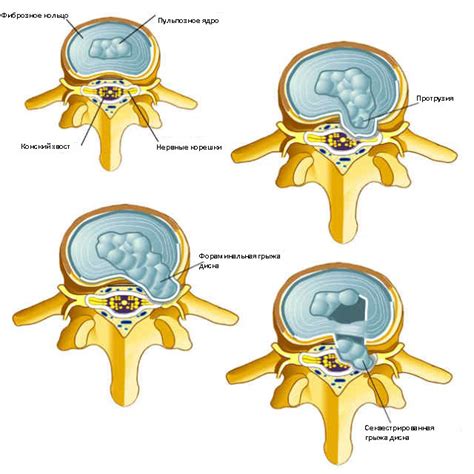 Методы лечения экструзии межпозвонковых дисков