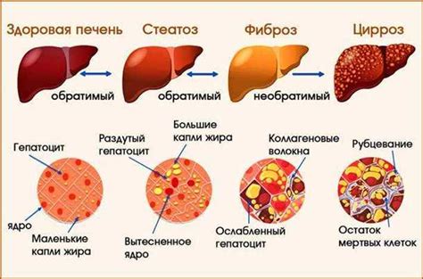 Механизмы метаболического разрушения печени