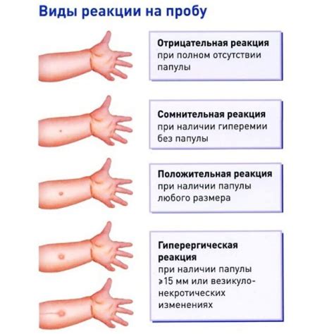 Механизм проведения вираж пробы манту