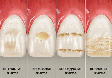 Механические повреждения эмали