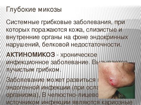 Микозы и грибок