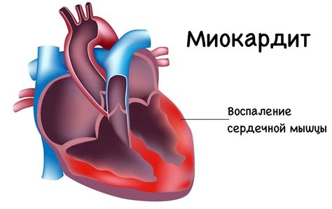 Миокардит: воспаление сердечной мышцы и его последствия