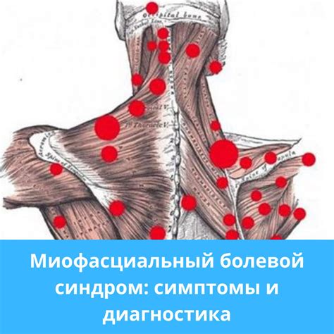 Миофасциальный болевой синдром: как облегчить боль