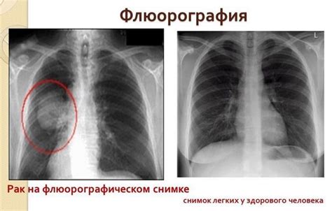 Можно ли увидеть признаки курения на флюорографии без клинических симптомов?