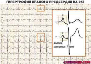 Нагрузка на правое предсердие на ЭКГ