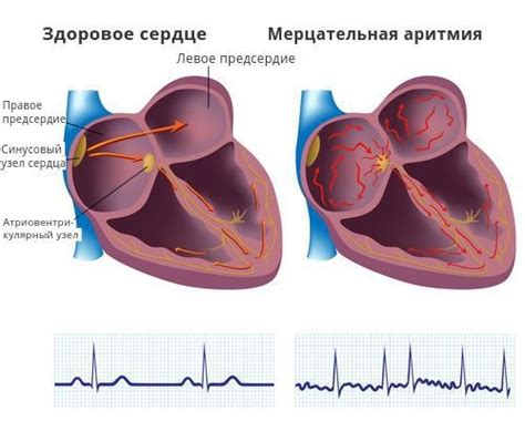 Наджелудочковая аритмия