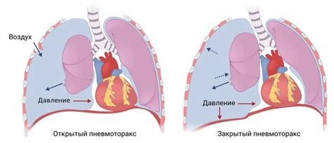 Напряженный пневмоторакс: последствия и профилактика