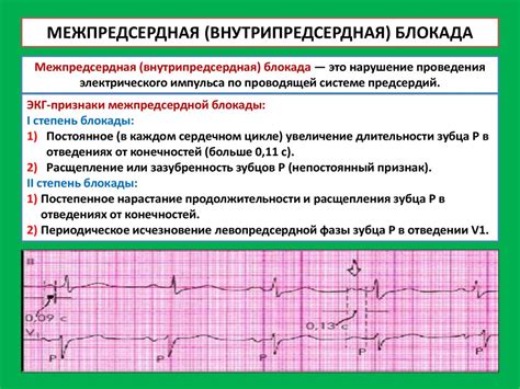 Нарушения внутрипредсердной проводимости на ЭКГ