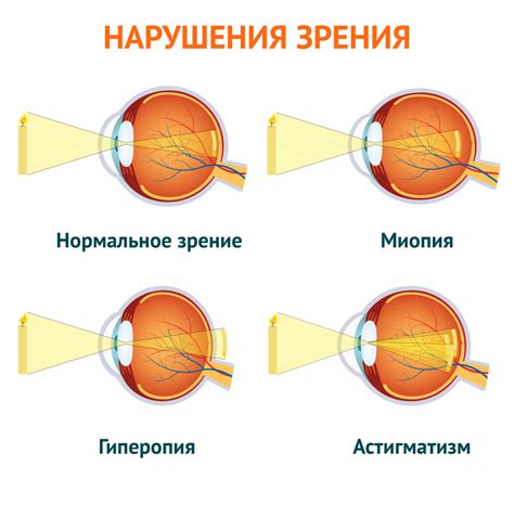 Нарушения зрения, вызванные помутнением глаза