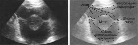 Научно-медицинская информация о жидкости в дугласовом пространстве на УЗИ