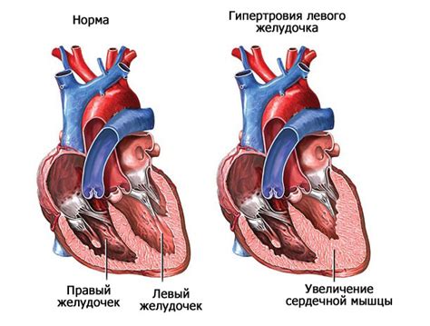 Начальная гипертрофия левого желудочка сердца: симптомы, причины и лечение