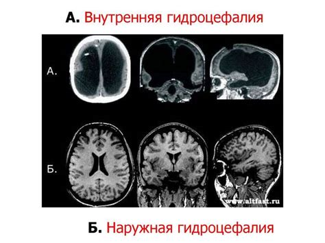 Начальные проявления наружной заместительной гидроцефалии