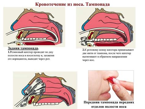 Неверный метод остановки кровотечения из носа