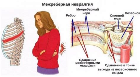 Невралгия межреберных нервов