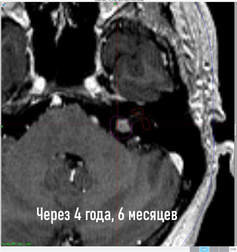 Невринома левого мму: