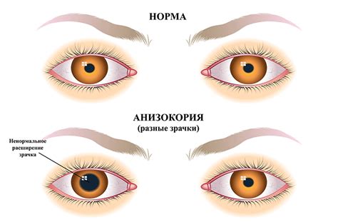 Неврологические причины асимметрии зрачков и их последствия