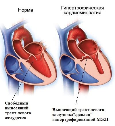 Неврологические причины тахикардии левого желудочка