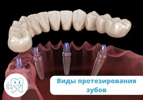 Недостатки съемного протезирования зубов