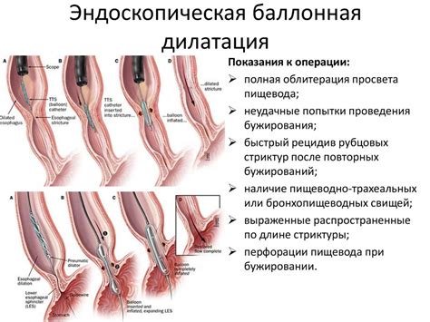 Недостаточность клапанов пищевода и желудка