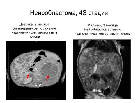 Нейробластома: различия, симптомы и диагностика