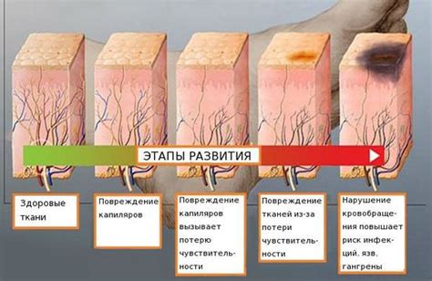 Нейропатия и невропатия: что это?