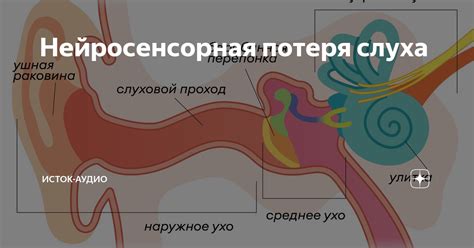 Нейросенсорная односторонняя потеря слуха: