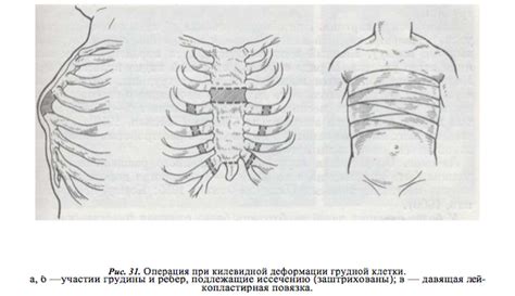 Некомплексные методы лечения выпирающей грудины