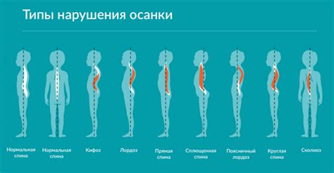 Некорректная осанка и способы ее исправления