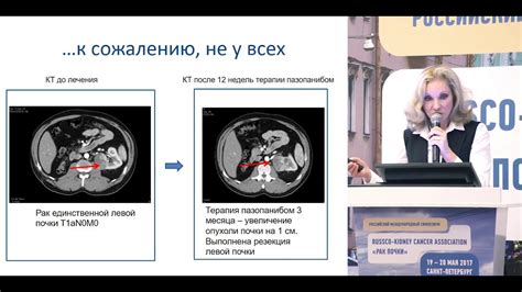 Неоадъювантная терапия: сущность и ее роль в лечении