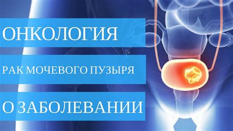 Неопластический процесс мочевого пузыря: всё, что вам нужно знать