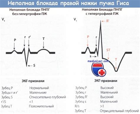 Неполная блокада ПНПГ: суть нарушения