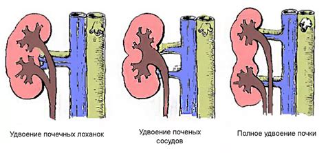 Неполное удвоение почки на узи