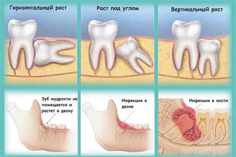 Неправильное положение зуба мудрости