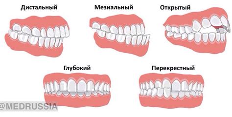 Неправильный прикус и его последствия