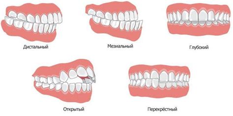 Неправильный прикус может приводить к дерганию подбородка