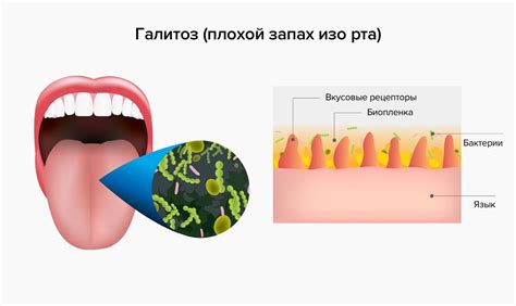 Неприятный запах изо рта: лингвистический порч и причины