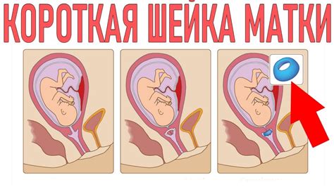 Несозревшая шейка матки в 39 недель беременности