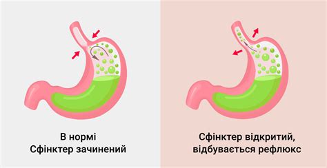 Неспецифический эзофагит