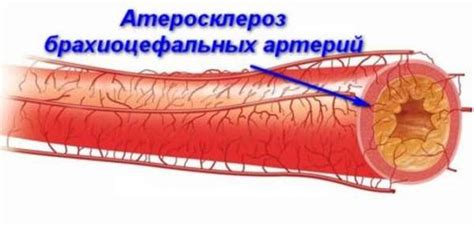 Нестенозирующий атеросклероз внечерепных отделов брахиоцефальных артерий