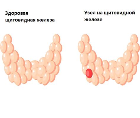 Нетоксический зоб и его симптомы