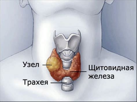 Нетоксичный узловой зоб щитовидной железы