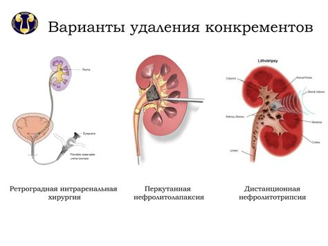 Нефролитиаз почек: причины, симптомы и лечение