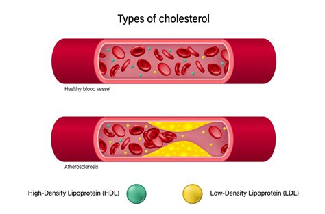 Ниацин и уровень холестерина в организме