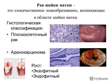 Новообразование шейки матки