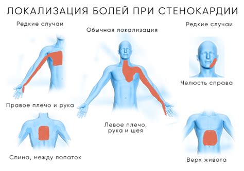 Облегчение боли в стенокардии