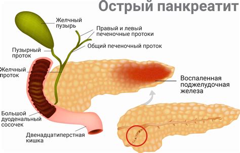 Облегчение симптомов острого билиарного панкреатита: что поможет?