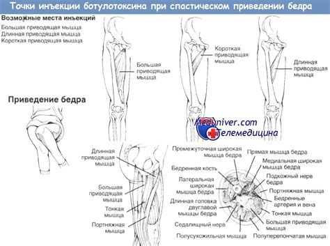 Общая техника приведения бедра