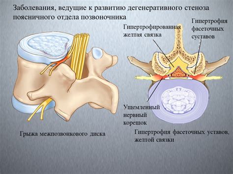 Обызвествление связок: симптомы, лечение и профилактика